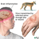 Illustration for article titled 5 real diseases that could make you act just like a zombie